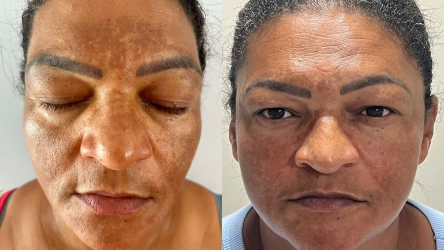 Antes e depois: melasma espalhado pelo rosto em pele morena, com as manchas mais claras