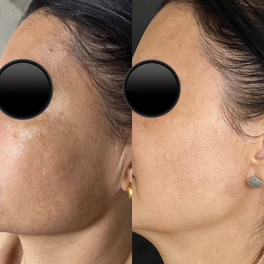 Antes e depois: melasma na lateral do rosto com a pele mais uniforme